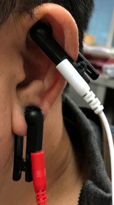 ELECTRODO PINZA CLIP PARA ESTIMULACION AURICULAR TRANSCUTANEA - Imagen 7